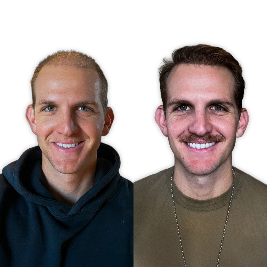 Before and after unshaven transplant — 3,200 grafts, patient from Munich